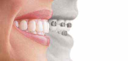 Apparecchio Denti