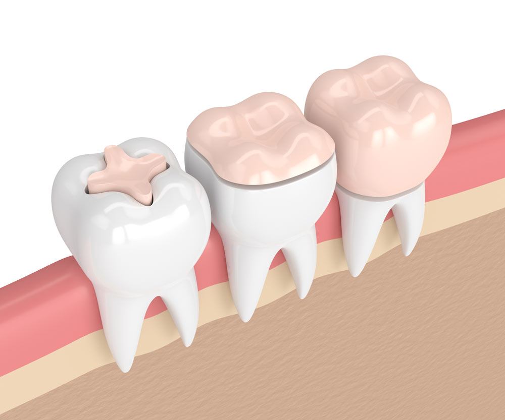 Intarsi-dentali