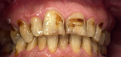 Macchie Scure sui Denti