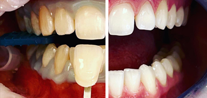 Sbiancamento dei Denti