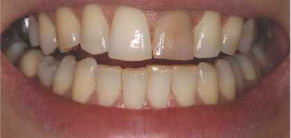 Dente Nero (Dente Necrotico)