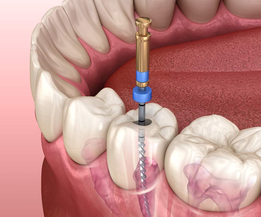 devitalizzazione-dente