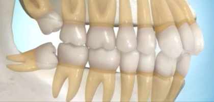 Estrazione dei Denti del Giudizio