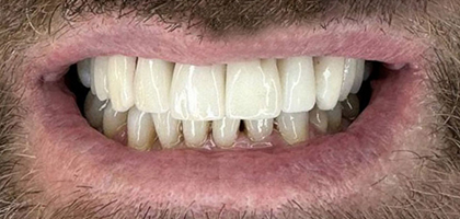 Faccette Dentali