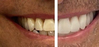 Faccette Estetiche