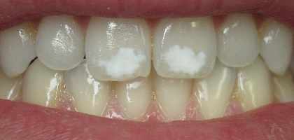 Macchie Bianche sui Denti
