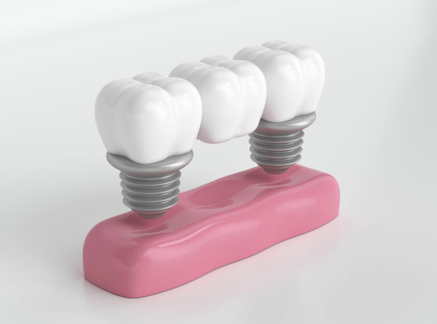 Corone-dentali-a-Roma