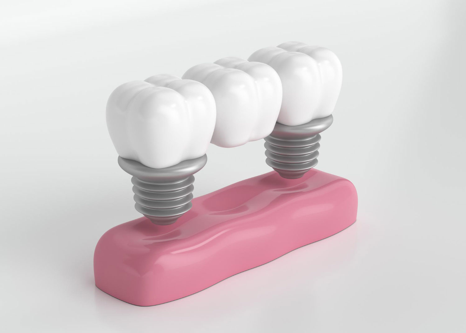Corone-dentali-a-Roma