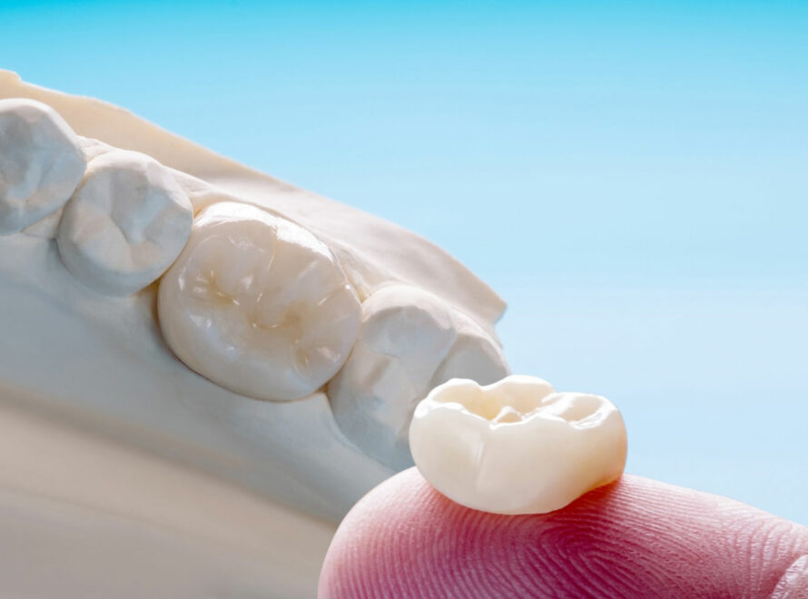 capsula-dentale-a-Roma