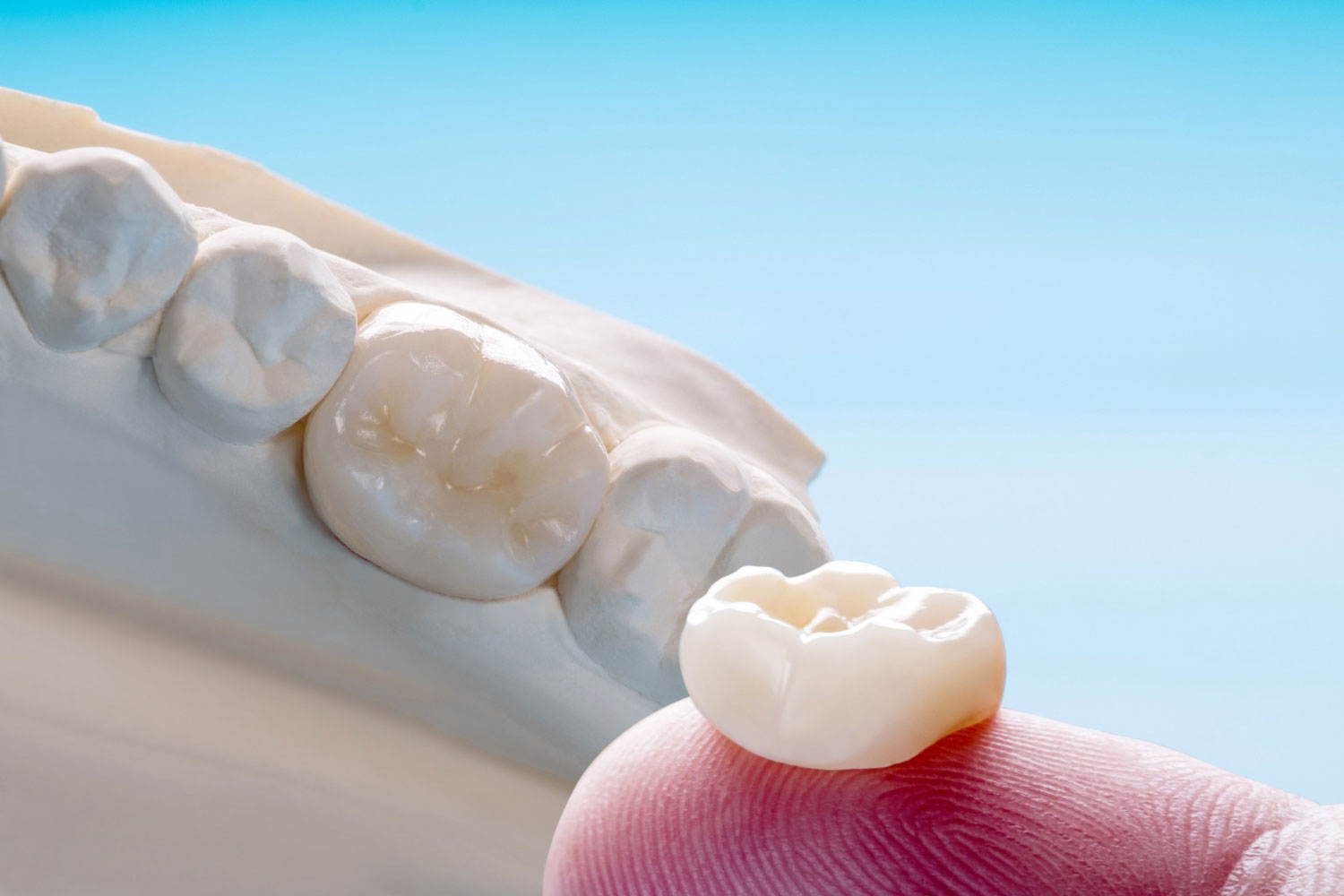 capsula-dentale-a-Roma