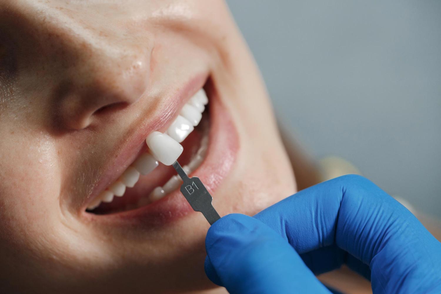 faccette-dentali-a-roma