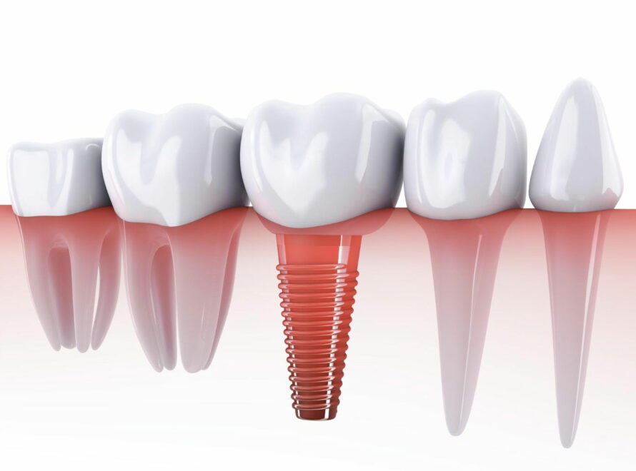 implantologia-dentale-a-roma
