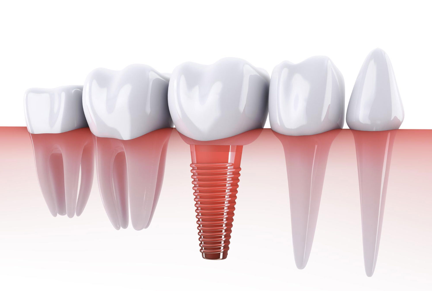implantologia-dentale-a-roma